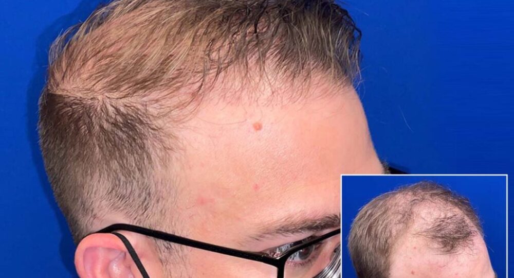 Hair transplant chicago
