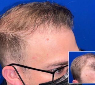 Hair transplant chicago