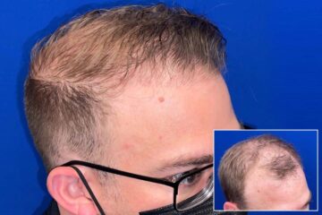 Hair transplant chicago